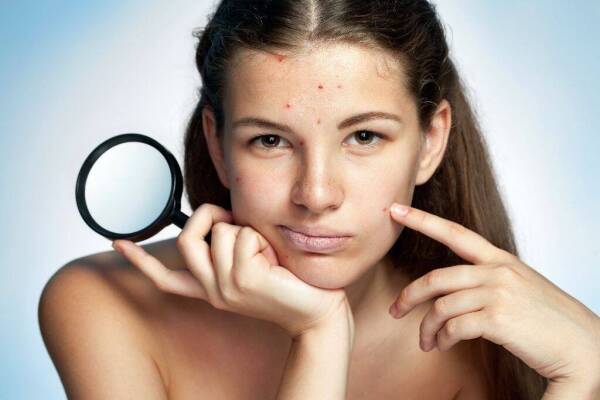 diferencias entre acné y rosácea
