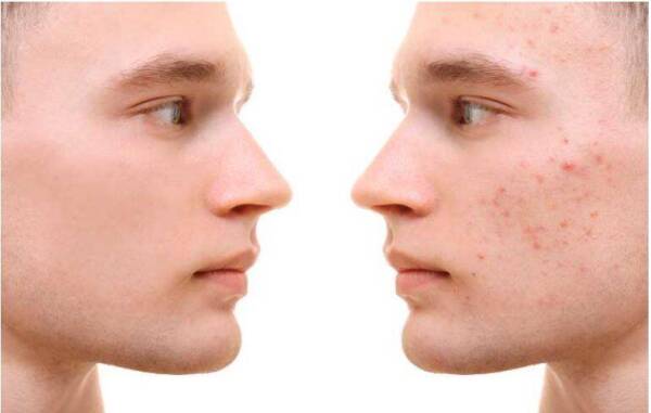 Secuelas del acné
